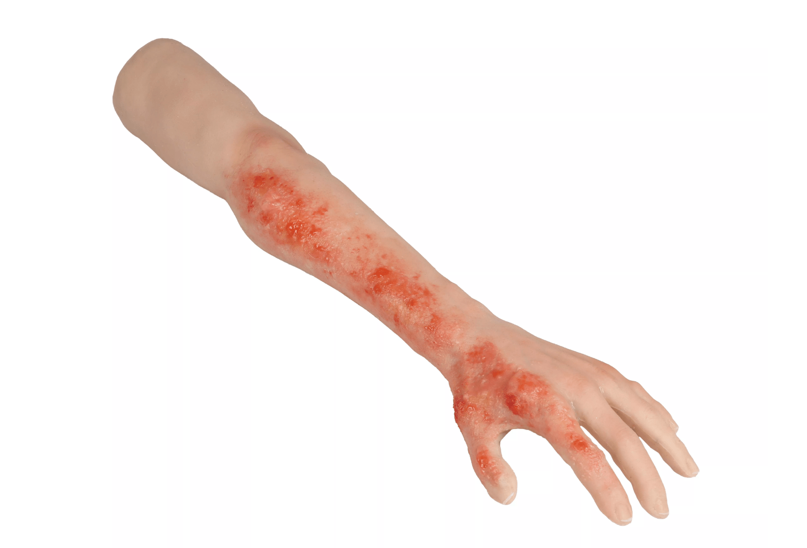 Arm mit Verbrennungen Task - Trainer - Erler - Zimmer